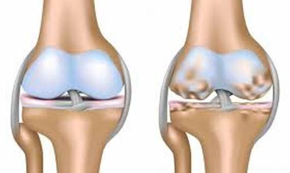 knee osteoarthritis treatment in indore