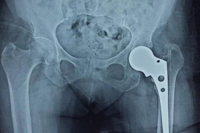 partial-hip-replacement-surgery-in-indore