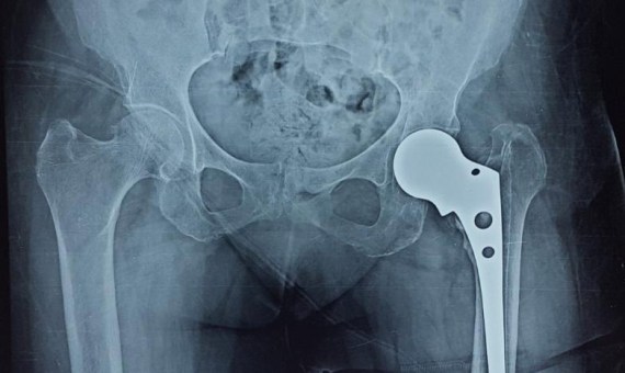 partial-hip-replacement-surgery-in-indore