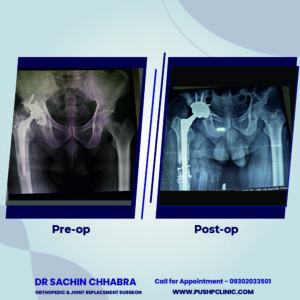 Operated for fracture acetabulum about 20 yrs back, 65 yrs old male came to us with severe thigh pain and inability to bear any weight on right lower limb